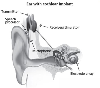 Cochlear Implants