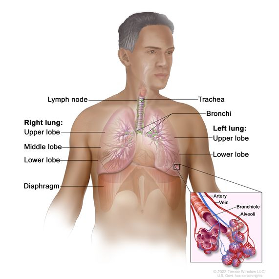 Lung cancer