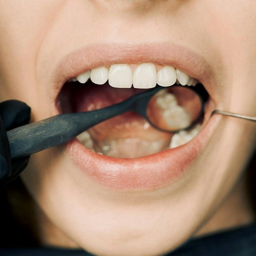 Tooth Decay