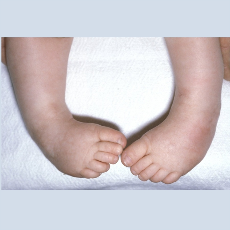 Club foot
